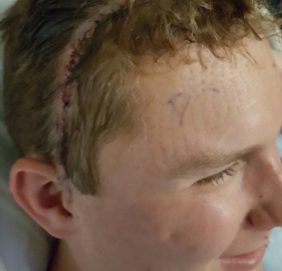Matt Tifft displays the stitches after brain surgery to remove a benign tumor on July 1. (Photo: Matt Tifft)